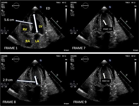 left ventricular intracavitary gradient.